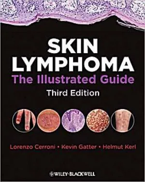 Skin lymphoma. The illustrated guide