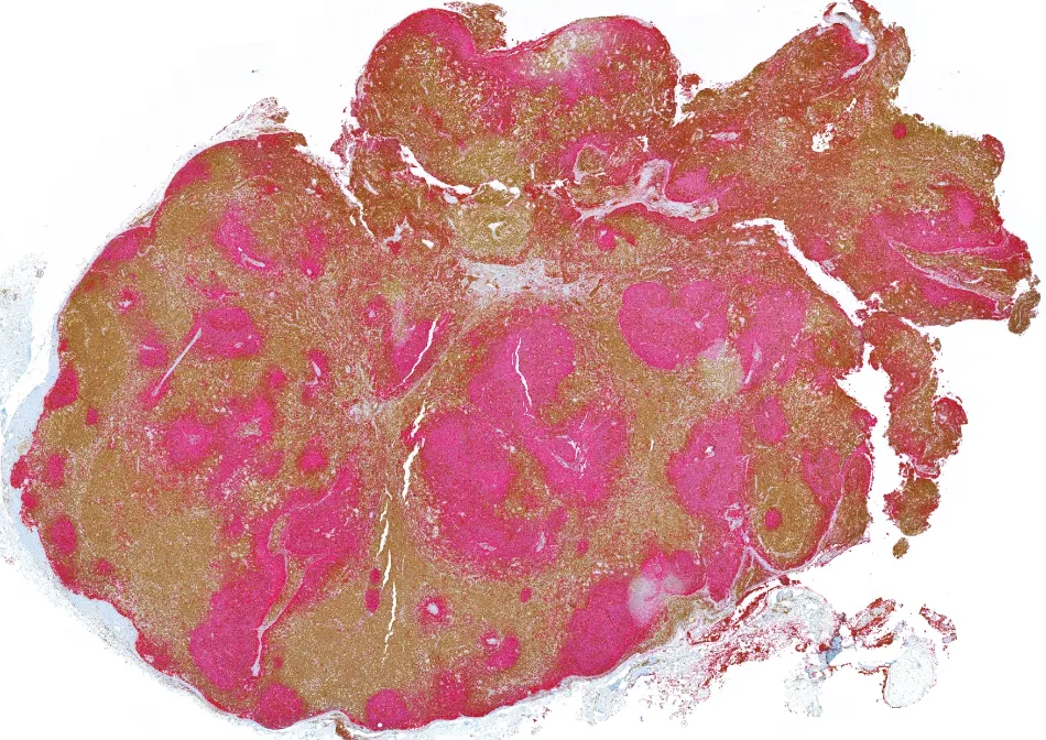 3. CD3 (marrón) - CD20 (rojo) 2x